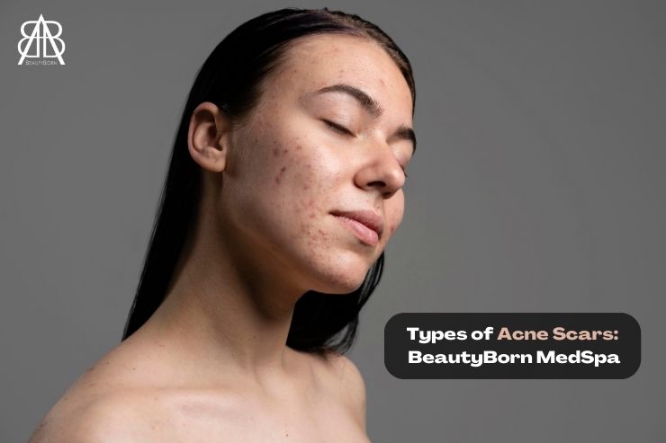 You are currently viewing TYPES OF ACNE SCARS – BEAUTYBORN MEDSPA, PHOENIX, ARIZONA, WHERE TIMELESS BEAUTY IS BORN!