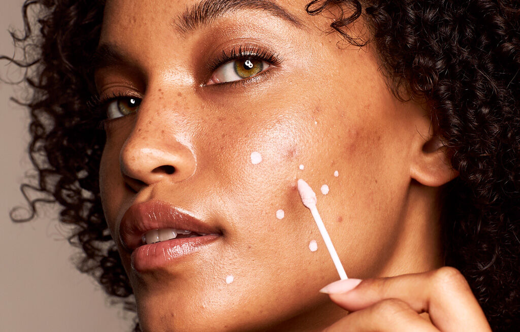 Hormonal Acne and How to Get Rid of Acne Scars - BeautyBorn MedSpa