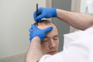 Read more about the article Everything You Need to Know About Alma Ted Hair Restoration | Beautyborn Medspa