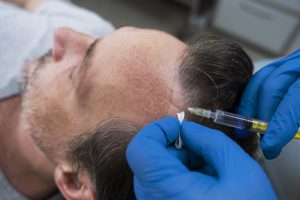 Read more about the article Hair Loss and Thyroid – Learn Everything About Hair Loss and Its Connection with Thyroid Disease!